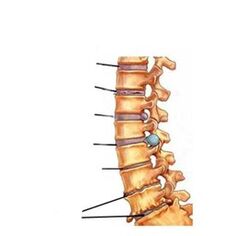 faze razvoja osteohondroze