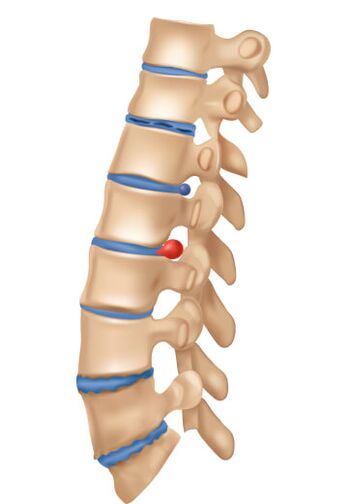 Kako izgleda deofrming osteohondroza