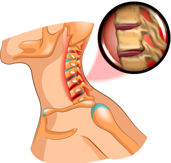 osteohondroza u vratu